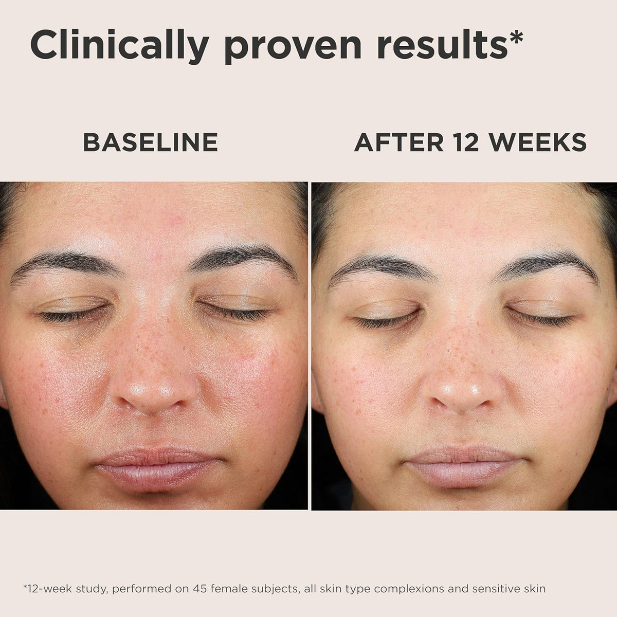 EltaMD UV Skin Recovery Face Sunscreen with Zinc Oxide, All Mineral, Safe for Sensitive Skin SPF 50