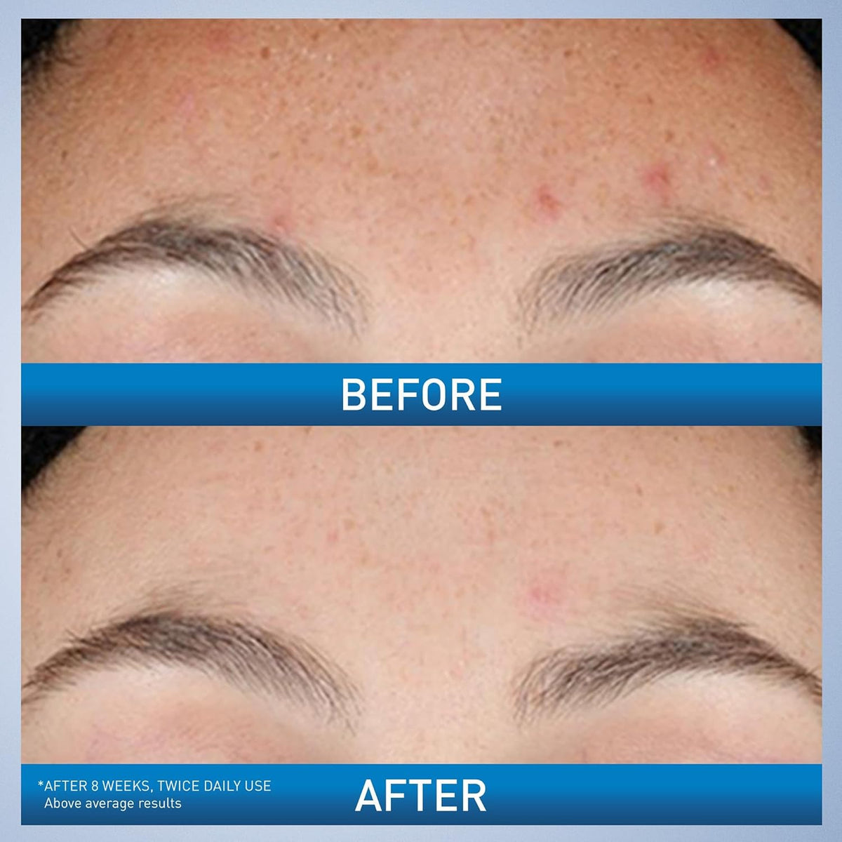 CeraVe Resurfacing Retinol Serum, Daily Brightening Face Serum with Licorice Root Extract & Niacinamide
