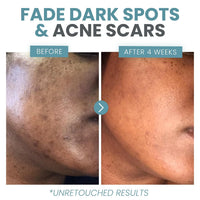 Eva Naturals Vitamin C Face Serum With Hyaluronic Acid - Anti Aging Serum - Reduce Dark Spots, Acne & Wrinkles - Retinol, Niacinamide & Salicylic Acid, Brightening Skin Serum for Glowing Skin