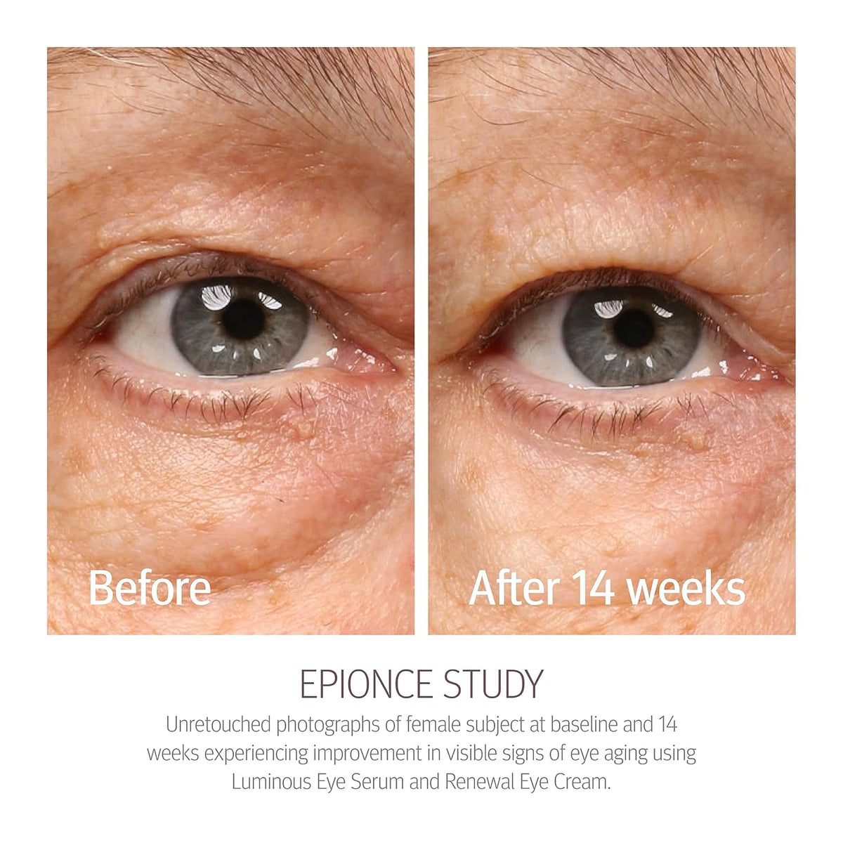 Epionce Renewal Eye Cream - Anti-Aging, Under Eye Cream for Dark Circles, Fine Lines, Wrinkles & Puffiness with Hyaluronic Acid, For All Skin Types, Dermatologist Skincare