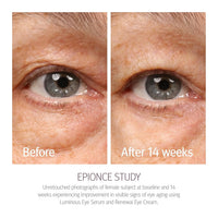 Epionce Renewal Eye Cream - Anti-Aging, Under Eye Cream for Dark Circles, Fine Lines, Wrinkles & Puffiness with Hyaluronic Acid, For All Skin Types, Dermatologist Skincare